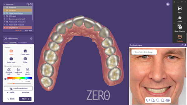 스마일 크리에이터 모듈을 통해 사용자는 이제 더욱 사실적인 결과를 위해 가상 치은을 디자인하고 환자의 자연 치아를 기반으로 미소를 만들 수 있다. (출처: exocad)