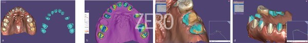 그림 22a~d. repositioning 전후 지대치 데이터를 매칭했다. 전체가 평균적으로 매칭하는 위치에서 맞추는데 최원심부에 큰 차이가 있었다.