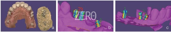 그림 30a~c. 기존의 verification index를 사용한 임플란트 repositioning. 매칭 후 컬러 맵을 보면 다양한 부분이 일치하지 않는다. 전체적으로 조화롭게 매칭하는 상태가 반드시 정답은 아니다.